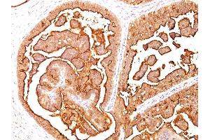 Formalin-fixed, paraffin-embedded human Breast Carcinoma stained with MUC-1 / EMA Mouse Monoclonal Antibody (MUC1/520)