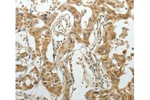 Immunohistochemical analysis of paraffin-embedded Human lung cancer tissue using at dilution 1/70.