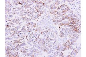 IHC-P Image NDRG1 antibody detects NDRG1 protein at membrane on human liver carcinoma by immunohistochemical analysis.