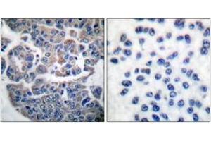 Immunohistochemistry analysis of paraffin-embedded human breast carcinoma, using eEF2K (Phospho-Ser366) Antibody.