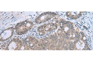 Immunohistochemistry of paraffin-embedded Human gastric cancer tissue using CCNG1 Polyclonal Antibody at dilution of 1:30(x200)