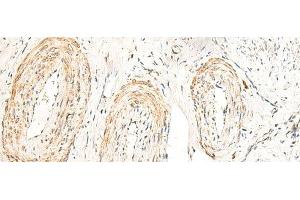 Immunohistochemistry of paraffin-embedded Human cervical cancer tissue using GPR160 Polyclonal Antibody at dilution of 1:35(x200)