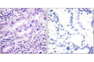 Immunohistochemistry analysis of paraffin-embedded human lung carcinoma, using PP2A-alpha (Phospho-Tyr307) Antibody.