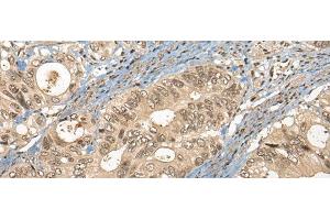 Immunohistochemistry of paraffin-embedded Human colorectal cancer tissue using CC2D1A Polyclonal Antibody at dilution of 1:35(x200)