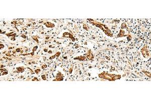 Immunohistochemistry of paraffin-embedded Human prost at e cancer tissue using GPR160 Polyclonal Antibody at dilution of 1:35(x200)