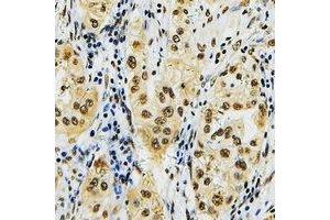 Immunohistochemical analysis of ID4 staining in human lung cancer formalin fixed paraffin embedded tissue section.