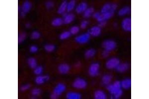 Immunofluorescence analysis of Human liver cancer tissue using XRCC4 Monoclonal Antibody at dilution of 1:200.