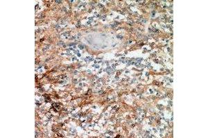 Immunohistochemical analysis of Nanos 1 staining in human breast cancer formalin fixed paraffin embedded tissue section.