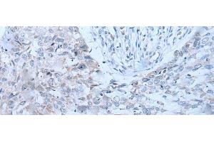 Immunohistochemistry of paraffin-embedded Human lung cancer tissue using XRN1 Polyclonal Antibody at dilution of 1:25(x200)