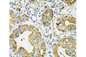 Immunohistochemistry of paraffin-embedded Human gastric cancer using HSPA9 Polyclonal Antibody at dilution of 1:100 (40x lens).