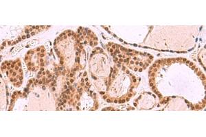 Immunohistochemistry of paraffin-embedded Human thyroid cancer tissue using MCMBP Polyclonal Antibody at dilution of 1:35(x200)