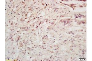 Formalin-fixed and paraffin embedded human colon carcinoma labeled with Rabbit Anti BMI1/PCGF4 Polyclonal Antibody, Unconjugated (ABIN682678) at 1:200 followed by conjugation to the secondary antibody and DAB staining