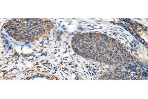 Immunohistochemistry of paraffin-embedded Human cervical cancer tissue using BRI3BP Polyclonal Antibody at dilution of 1:35(x200)