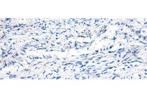 Immunohistochemistry of paraffin-embedded Human ovarian cancer tissue using FGF11 Polyclonal Antibody at dilution of 1:50(x200)