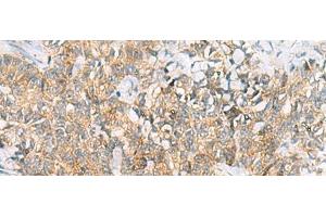 Immunohistochemistry of paraffin-embedded Human ovarian cancer tissue using TUFT1 Polyclonal Antibody at dilution of 1:120(x200)