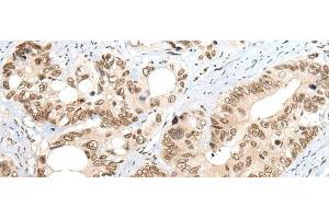 Immunohistochemistry of paraffin-embedded Human colorectal cancer tissue using ZNF83 Polyclonal Antibody at dilution of 1:50(x200)