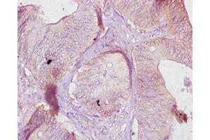 Immunohistochemistry of paraffin-embedded human colon cancer using ABIN7177073 at dilution of 1:10