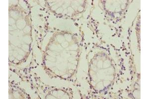 Immunohistochemistry of paraffin-embedded human colon cancer using ABIN7165635 at dilution of 1:100