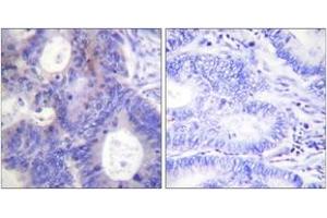 Immunohistochemistry analysis of paraffin-embedded human colon carcinoma, using TEBP (Phospho-Ser113) Antibody.