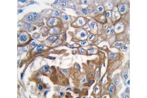 IHC analysis of FFPE human lung carcinoma tissue stained with NRAS antibody