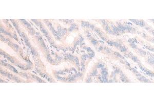 Immunohistochemistry of paraffin-embedded Human thyroid cancer tissue using TBC1D2 Polyclonal Antibody at dilution of 1:25(x200)
