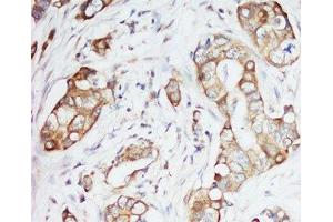 IHC-P: IGF-1 antibody testing of human breast cancer tissue