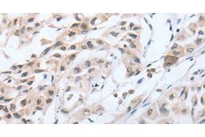 Immunohistochemistry of paraffin-embedded Human lung cancer tissue using CHRNA10 Polyclonal Antibody at dilution 1:50