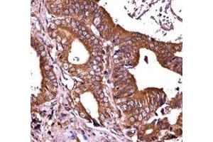 RIPK1 antibody immunohistochemistry analysis in formalin fixed and paraffin embedded human prostate carcinoma.