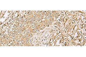 Immunohistochemistry of paraffin-embedded Human ovarian cancer tissue using QDPR Polyclonal Antibody at dilution of 1:70(x200)