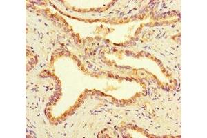 Immunohistochemistry of paraffin-embedded human prostate cancer using ABIN7168168 at dilution of 1:100