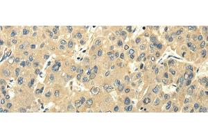 Immunohistochemistry of paraffin-embedded Human liver cancer using PMP2 Polyclonal Antibody at dilution of 1/25