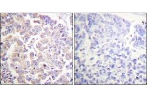 Immunohistochemistry analysis of paraffin-embedded human breast carcinoma, using APC1 (Phospho-Ser688) Antibody.