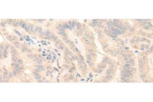Immunohistochemistry of paraffin-embedded Human thyroid cancer tissue using HMBS Polyclonal Antibody at dilution of 1:25(x200)