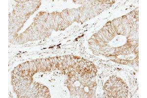 IHC-P Image Immunohistochemical analysis of paraffin-embedded human colon carcinoma, using GSTP1, antibody at 1:250 dilution.