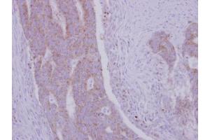 IHC-P Image Immunohistochemical analysis of paraffin-embedded human colon carcinoma, using RRM1, antibody at 1:500 dilution.