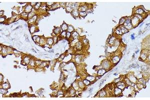 Immunohistochemistry of paraffin-embedded Human lung cancer using SEPT4 Polyclonal Antibody at dilution of 1:100 (40x lens).