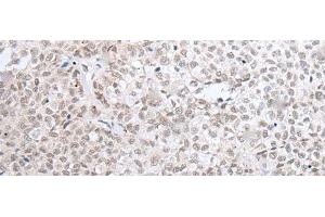 Immunohistochemistry of paraffin-embedded Human ovarian cancer tissue using HOXC11 Polyclonal Antibody at dilution of 1:25(x200)