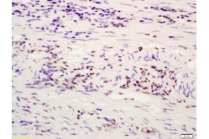Formalin-fixed and paraffin embedded human rectal carcinoma labeled with Anti-ATF4/CREB-2 Polyclonal Antibody, Unconjugated (ABIN687862) at 1:200 followed by conjugation to the secondary antibody and DAB staining