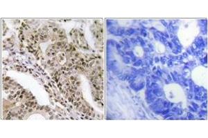 Immunohistochemistry analysis of paraffin-embedded human lung carcinoma, using AS160 (Phospho-Thr642) Antibody.