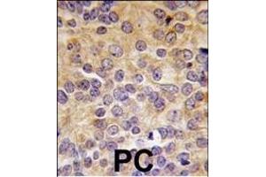 Formalin-fixed and paraffin-embedded human prostata carcinoma tissue reacted with PRMT3 antibody (N-term), which was peroxidase-conjugated to the secondary antibody, followed by DAB staining.