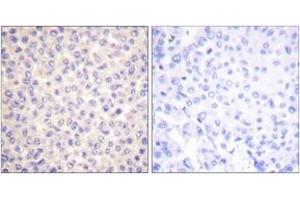 Immunohistochemistry analysis of paraffin-embedded human breast carcinoma, using FADD (Phospho-Ser194) Antibody.