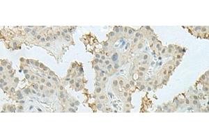 Immunohistochemistry of paraffin-embedded Human thyroid cancer tissue using MECOM Polyclonal Antibody at dilution of 1:60(x200)
