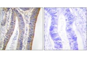 Immunohistochemistry analysis of paraffin-embedded human colon carcinoma, using p47 phox (Phospho-Ser359) Antibody.