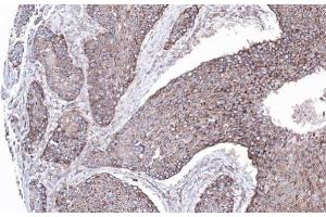 IHC-P Image Immunohistochemical analysis of paraffin-embedded lung SCC xenograft, using MAPK8IP1, antibody at 1:100 dilution.