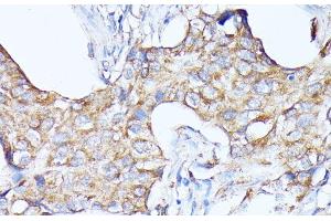 Immunohistochemistry of paraffin-embedded Human breast cancer using CTSF Polyclonal Antibody at dilution of 1:100 (40x lens).
