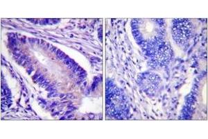 Immunohistochemistry analysis of paraffin-embedded human colon carcinoma, using eIF4B (Phospho-Ser422) Antibody.