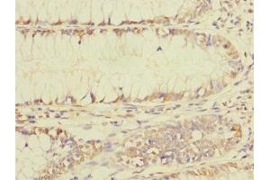 Immunohistochemistry of paraffin-embedded human colon cancer using ABIN7165123 at dilution of 1:100