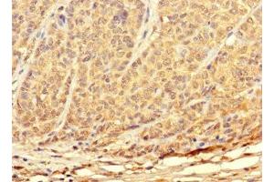 Immunohistochemistry of paraffin-embedded human ovarian cancer using ABIN7172897 at dilution of 1:100