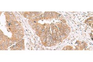 Immunohistochemistry of paraffin-embedded Human colorectal cancer tissue using HMGCLL1 Polyclonal Antibody at dilution of 1:70(x200)