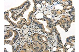 The image on the left is immunohistochemistry of paraffin-embedded Human thyroid cancer tissue using ABIN7193040(WDR36 Antibody) at dilution 1/35, on the right is treated with synthetic peptide.
